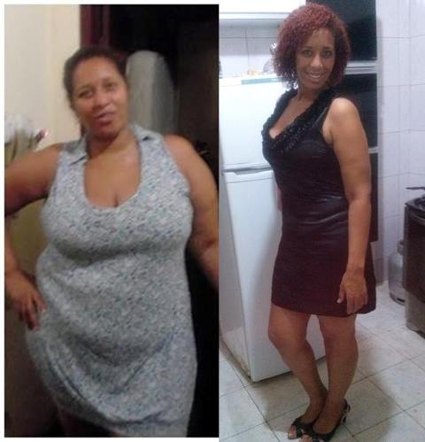 bariátrica antes e depois