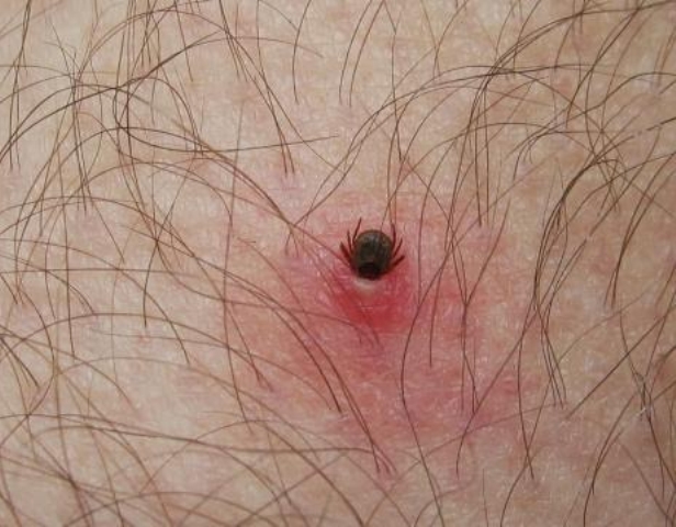 febre maculosa 2