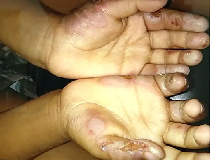Quedas e queimaduras são maior causa de internação de crianças
