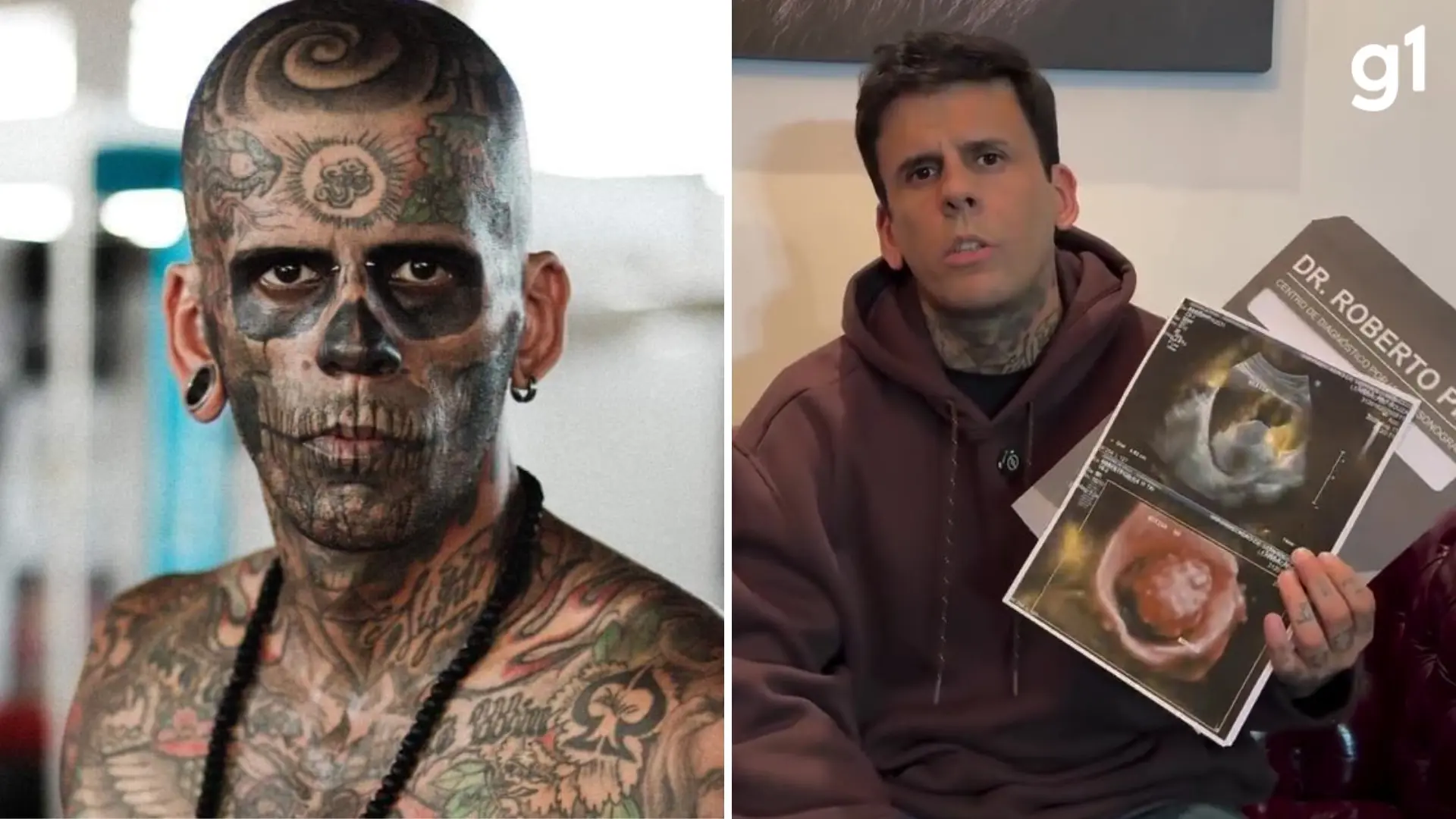 ‘Mais tatuado do Brasil’ diz que precisará retirar bexiga após diagnóstico de câncer